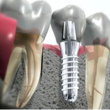 Имплантация зубов.jpg