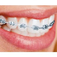 Брекет система на одну челюсть.jpg