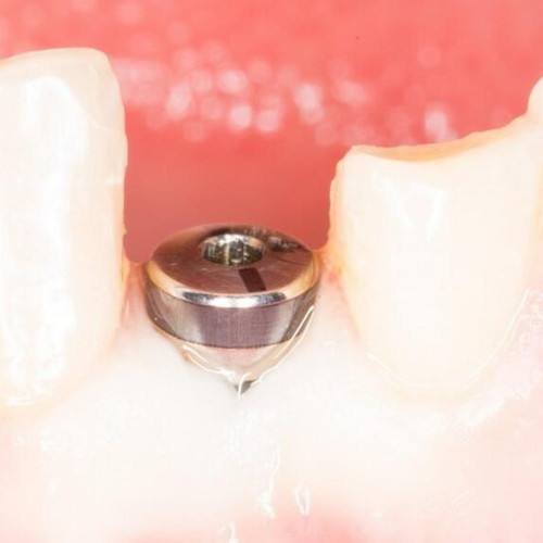 Установка формирователя десны (Osstem).jpg