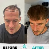 Dhi Hair Transplant Istanbul.jpg