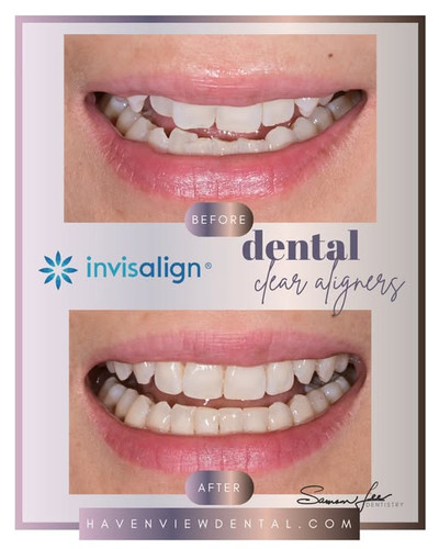 Invisalign Treatment Scarborough.jpg