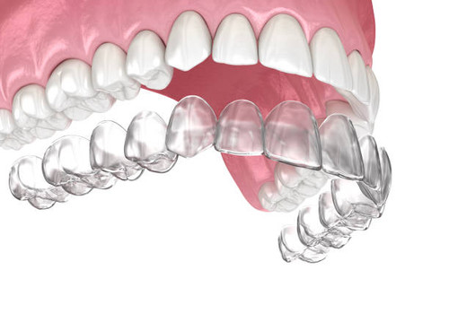 Upper East Side Invisalign Near Me.jpg