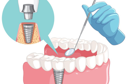 Complete Dental Implant.jpg