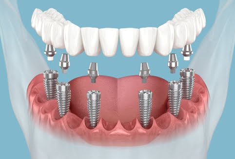 Dental Implant (4).jpg