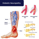 Diabetc Neuropath Treatmnt Broklyn