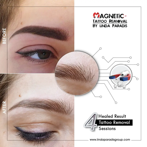 Magnetic Tattoo Removal for PMU & Microblading – Professional Training.png