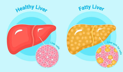 k fatty liver.jpg