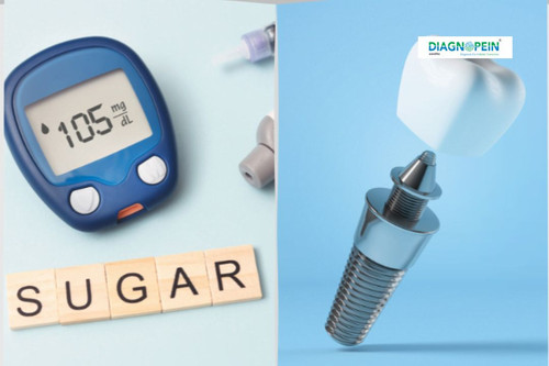 diabetes and dental implant.jpg