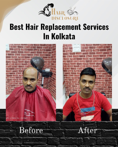 Hair Patch Services Kankurgachi - Hair Disclosure.jpg