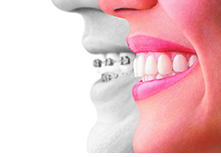 Rochester Hills Invisalign Clear Aligners.png