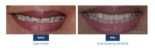 Gap Teeth.png