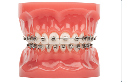 Charlotte Braces.png