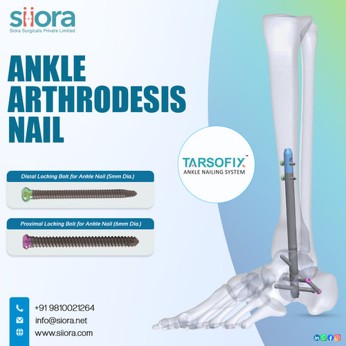 Ankle Arthrodesis Nail.jpg