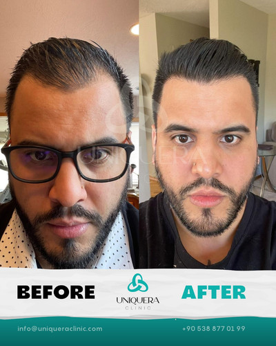 Receding Hair Transplant.jpg