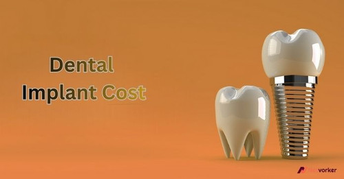 Dental Implant Cost.jpg