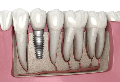 Dental Implants in Ahmedabad | Daivik Dental Clinic.jpg