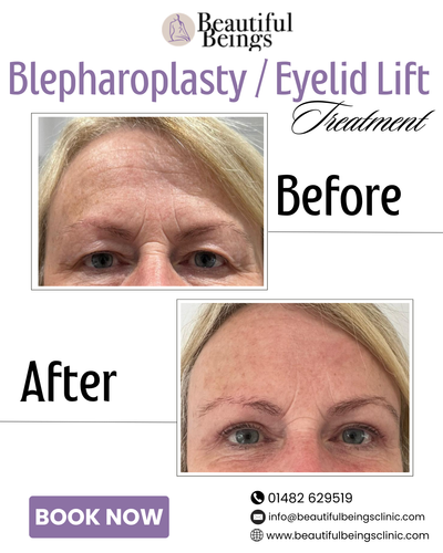 Blepharoplasty Eyelid Lift.png