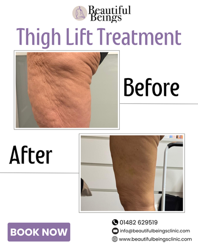 Thigh Lift Treatment.png