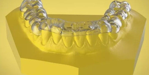 Сплинт терапия.jpg