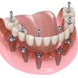 Установка 6 имплантов Straumann в Москве