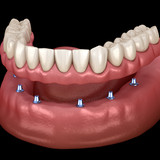 Установка 6 имплантов Nobel Biocare с собственной десной
