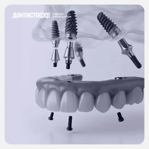 Восстановление всех зубов на 4 имплантах Osstem в Москве.webp
