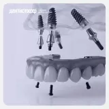 Восстановление всех зубов на 4 имплантах Osstem в Москве