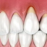 Закрытие рецессии десны в Москве