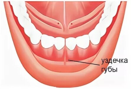 Пластика уздечки нижней губы.jpg