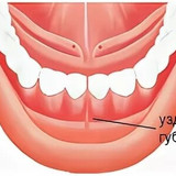 Пластика уздечки нижней губы