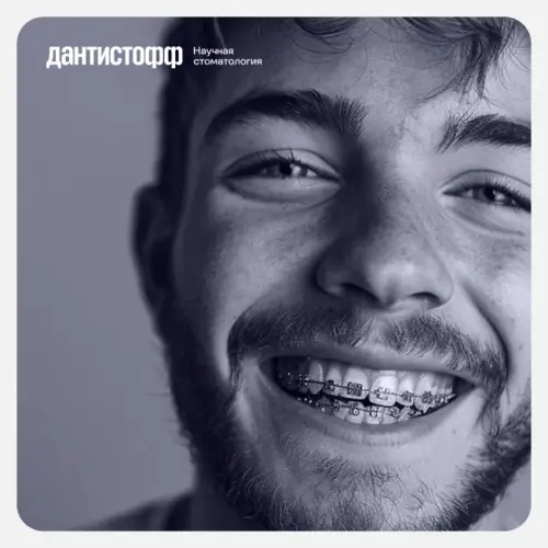 Металлические брекеты в рассрочку в Москве.webp