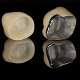 Металлокерамическая коронка на свой зуб