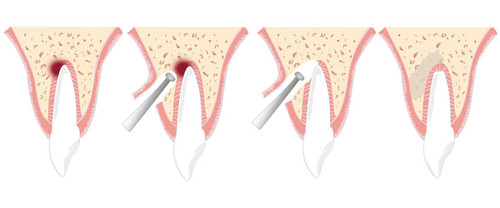 Резекция верхушки корня.jpg