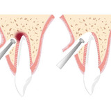 Резекция верхушки корня