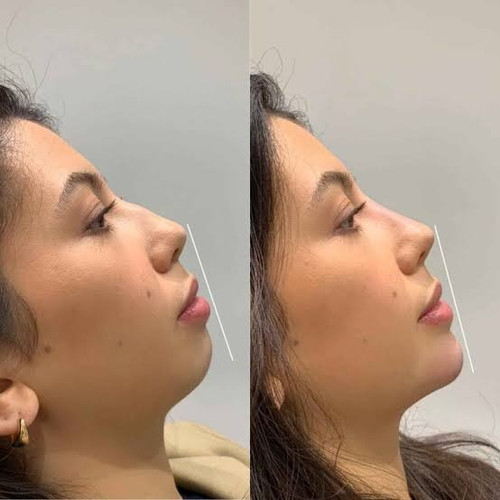 Nose Reshaping in London.jpg