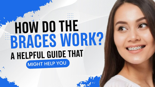 How Do the Braces Work A Helpful Guide That Might Help You.jpg