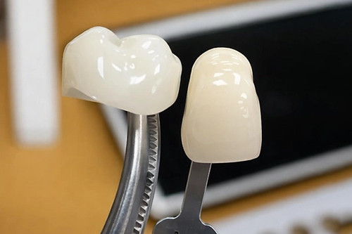 ceramic crown implant.jpg