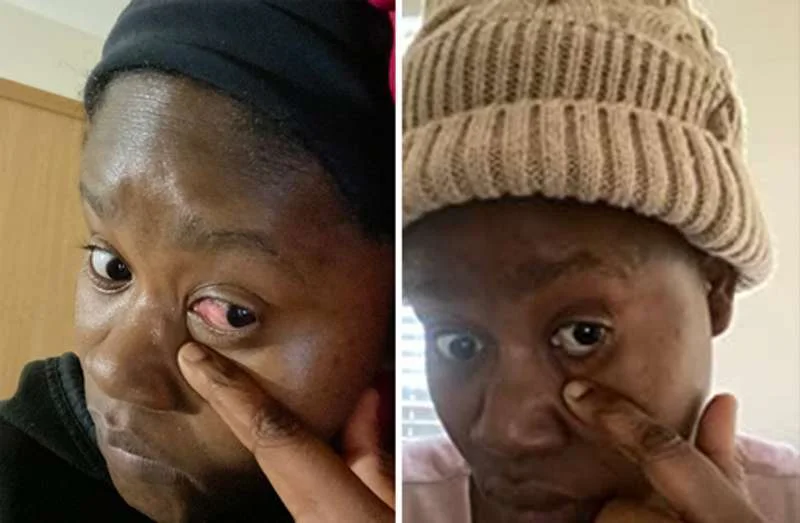 Female Customer Before and After Eye Redness Result