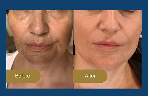 Best SQT Treatment For Wrinkles: Australia Guide.jpg