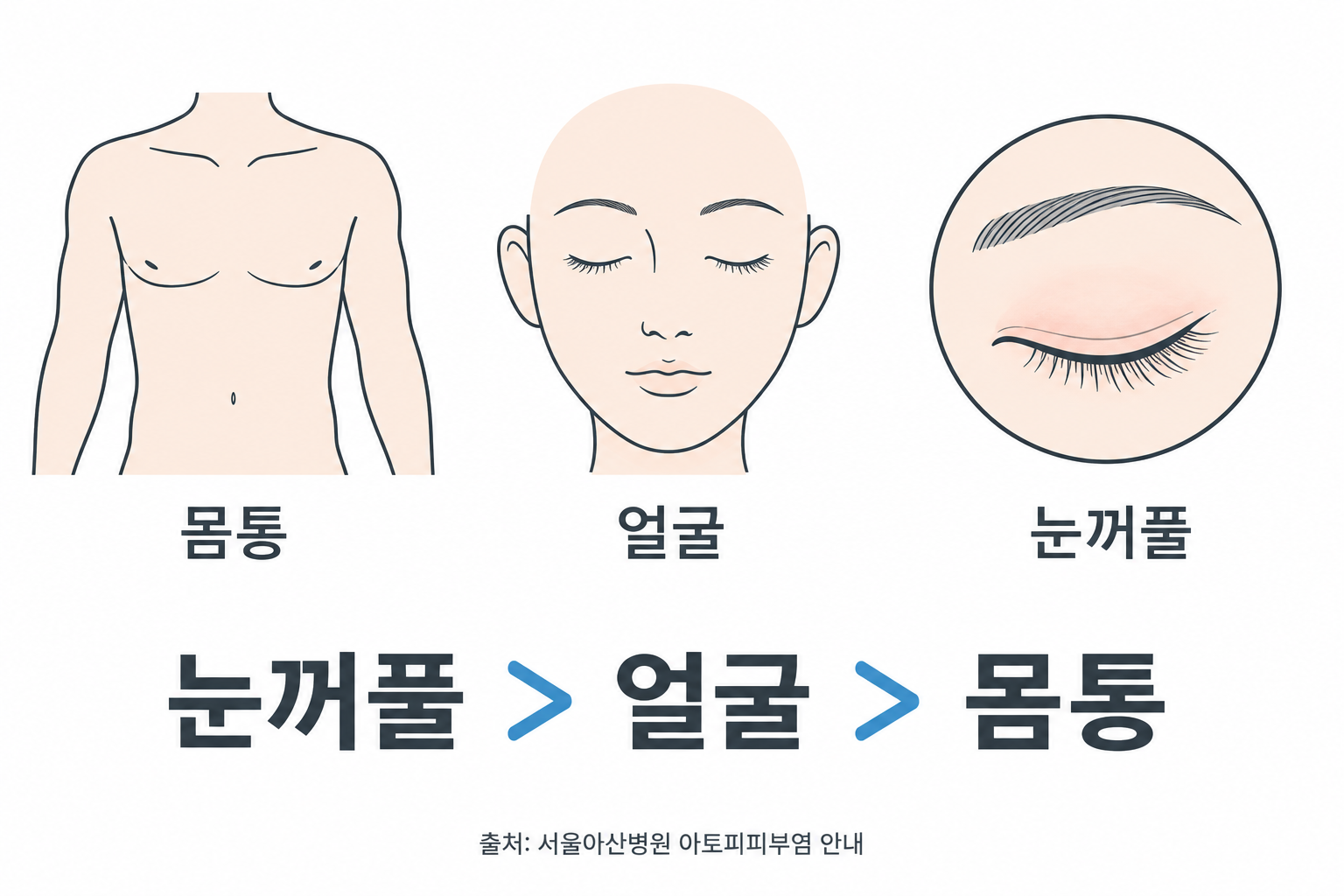 서울아산병원 아토피 안내의 눈꺼풀·얼굴·몸통 흡수 차이를 방향으로 보여주는 도식
