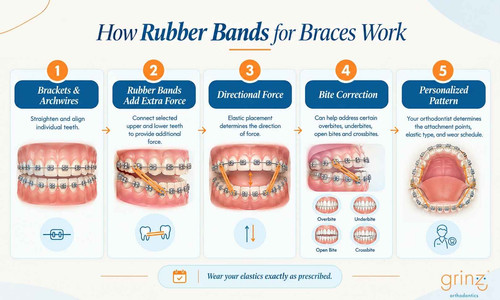How Rubber Bands for Braces Work.jpg
