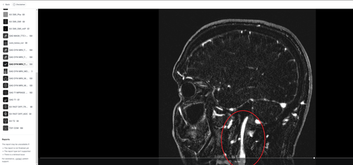 left side
