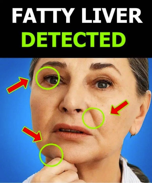 Everyone with fatty liver has this in common! A hidden sign you should know about.