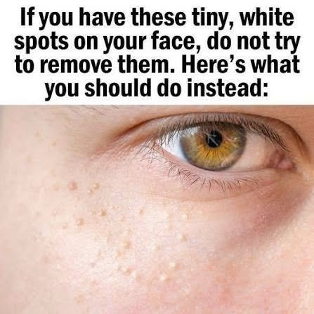 What Those Tiny White Bumps on Your Face Might Be — And What to Do About Them