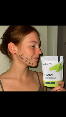 pad u07 no more hormonal acne.1
