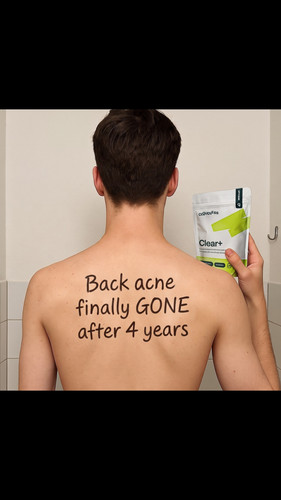 pad u13 back acne gone.1