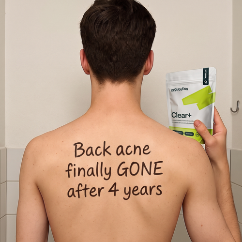 u13 back acne gone.png