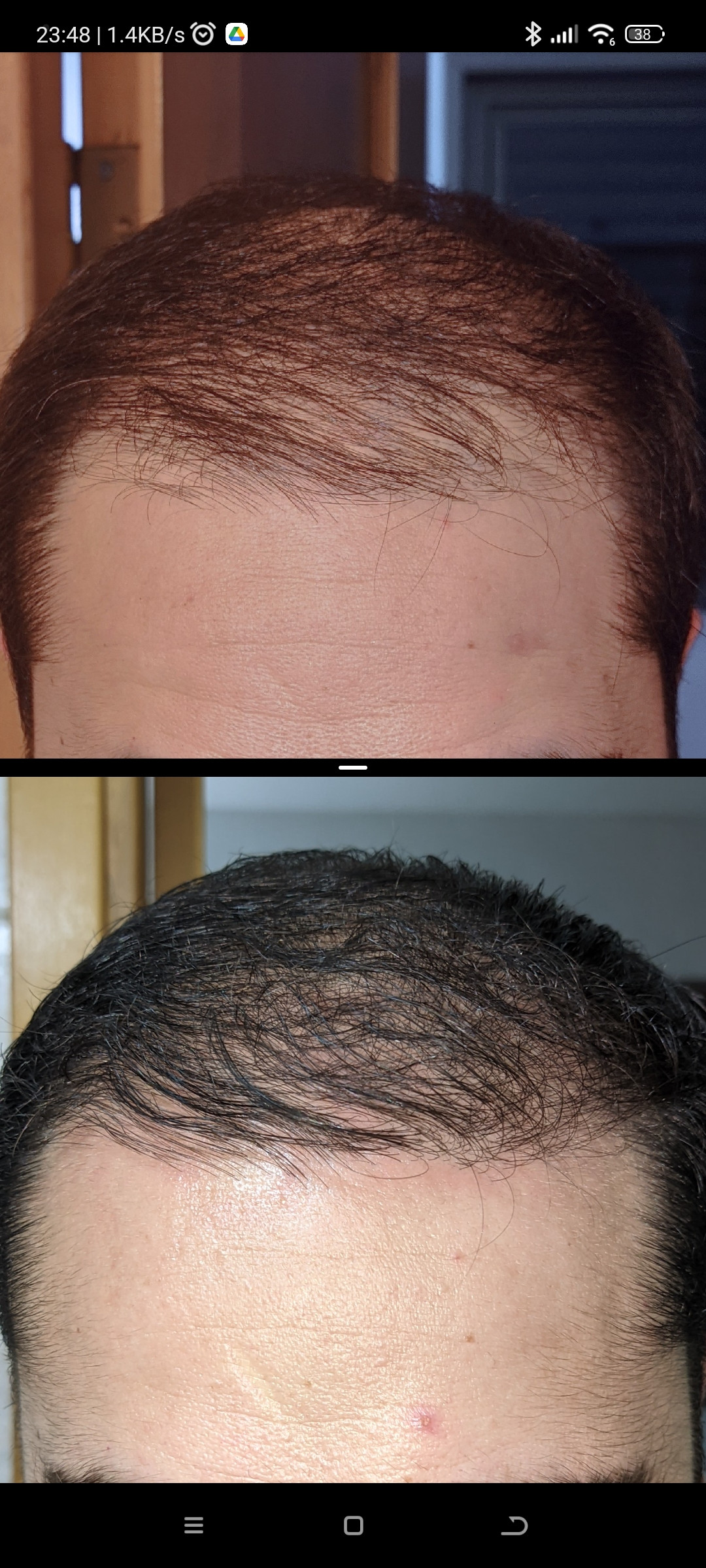 minoxidil shedding 2 <a href="https://digitales.com.au/blog/wp-content/review/hair-loss/is-topical-rogaine-safe-while-breastfeeding.php">go here</a> reddit
