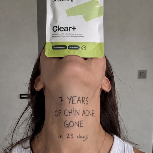 w29 chin acne neck.png