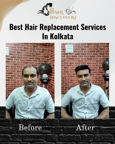 Best Hair Replacement Services in Kolkata - Hair Disclosure.jpg